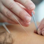 Acupuncture Treatment