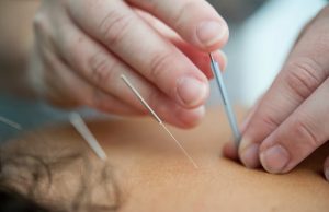 Acupuncture Treatment in Surrey