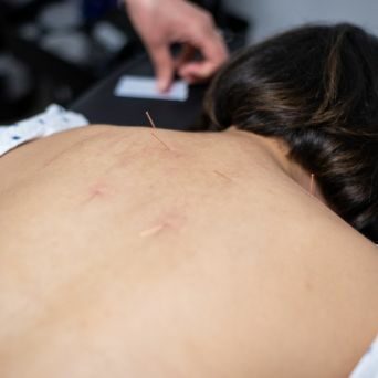 Acupuncture Langley and Surrey