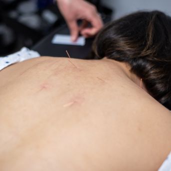 Acupuncture Surrey